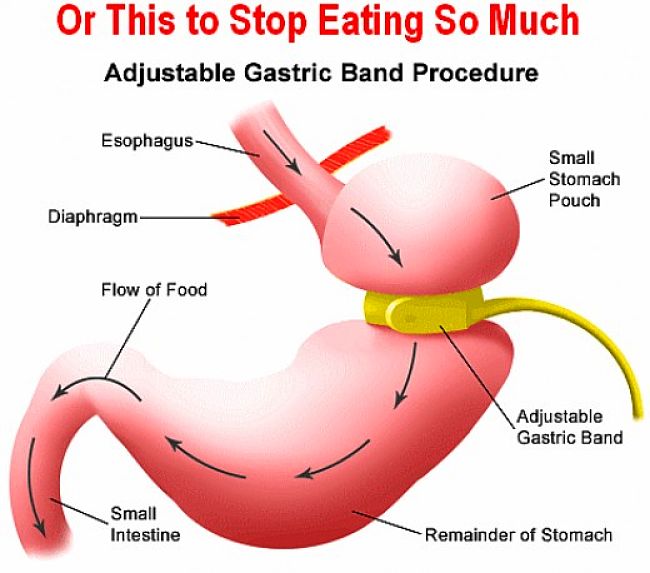 Stomach banding works