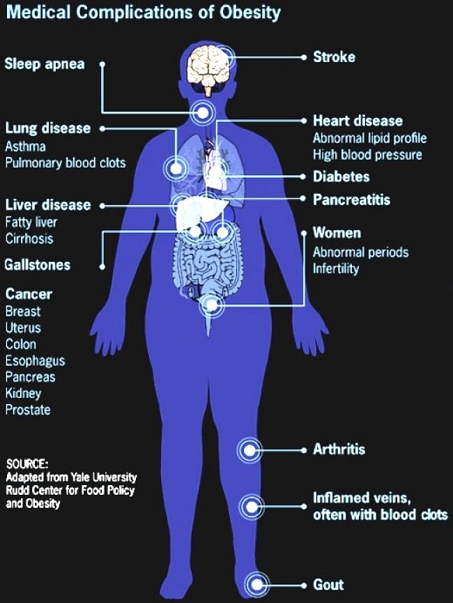 The Burden of Obesity on the Health Systems throughout the World is Immense