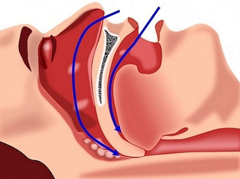 How sleep apnea is triggered and why your sleep is disturbed