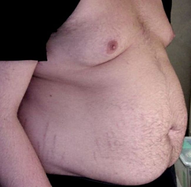 Belly fat is a risk for men. The 'piece of string' method directly scores this risk